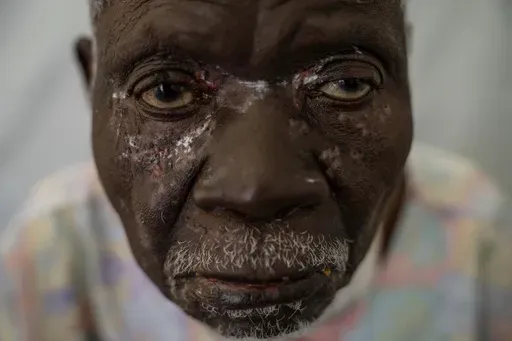 Christophe Chavilinga, 90, suffering from mpox, waits for treatment at a clinic in Munigi, eastern Congo, Friday, Aug. 16, 2024. (AP Photo/Moses Sawasawa)